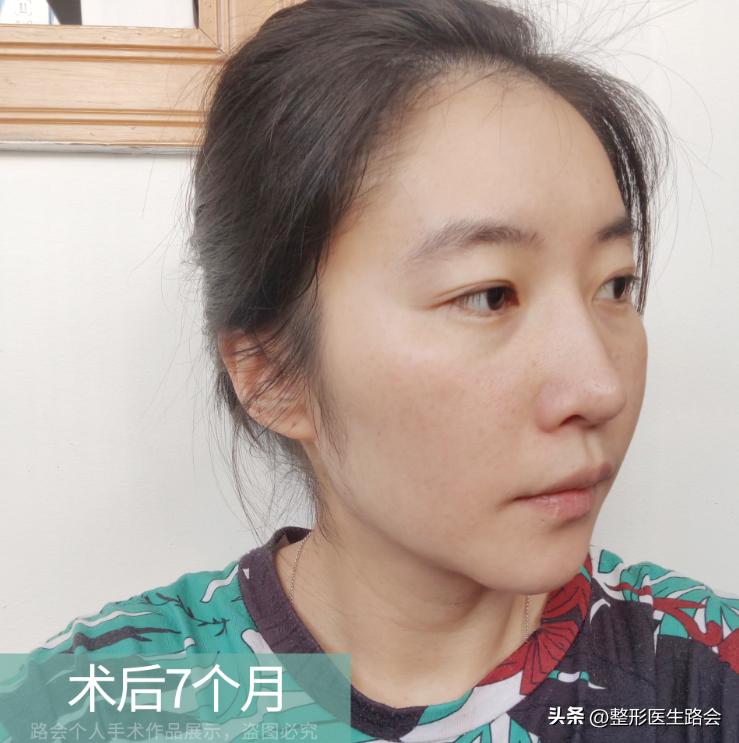 硅胶隆鼻恢复过程经历真实,我做了假体隆胸现在非常后悔
