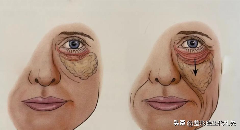 祛眼袋手术后凹陷多久恢复好,祛眼袋手术后眼眶处出现凹陷