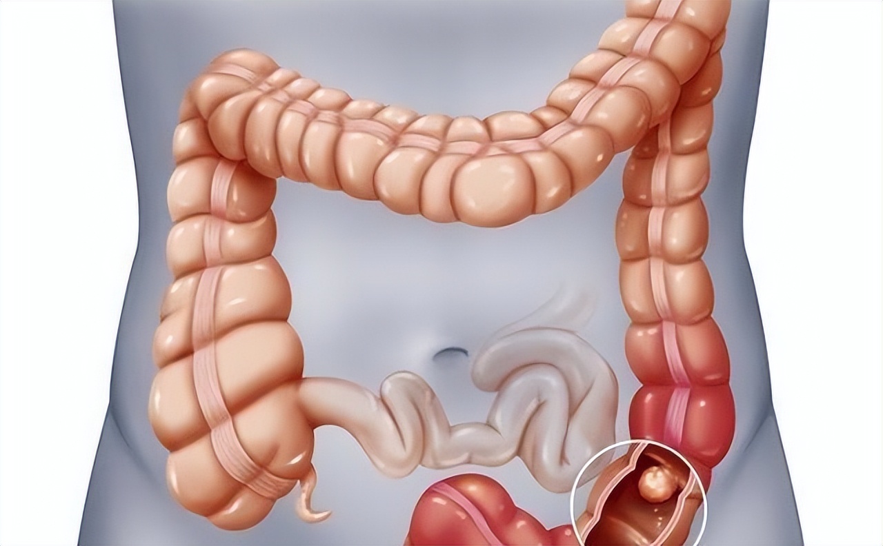 一次正常的肠镜可以确保多久,肠镜一次到底可以管多久