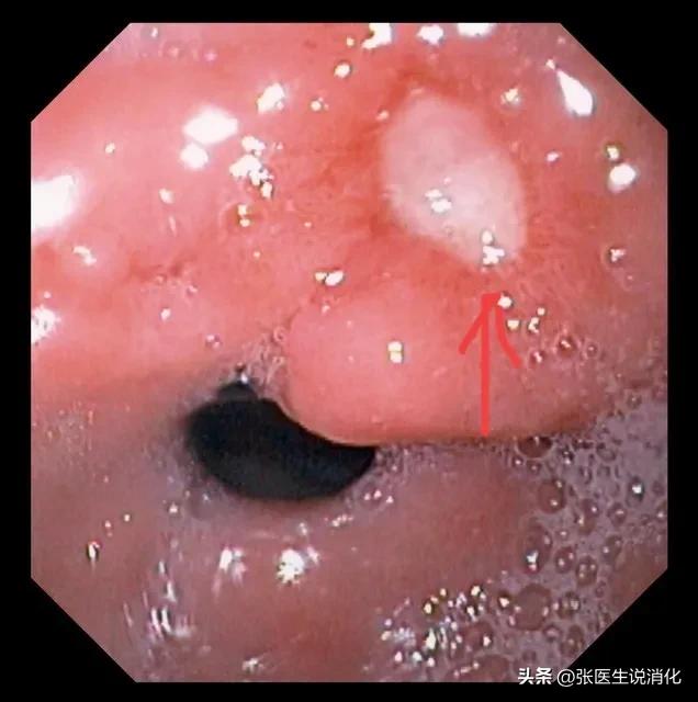 胃溃疡和胃糜烂会得胃癌吗,胃糜烂和胃溃疡是一回事吗