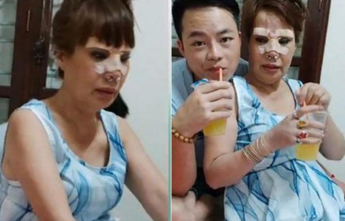 越南62岁老妇嫁给27岁小伙，还为他多次整容，如今却肿得不能看
