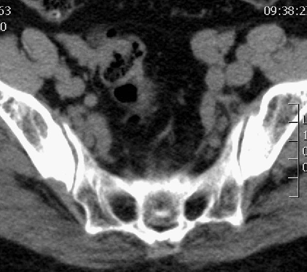老年女性骶骨受侵椎管骶管内富血供占位影诊思维过程