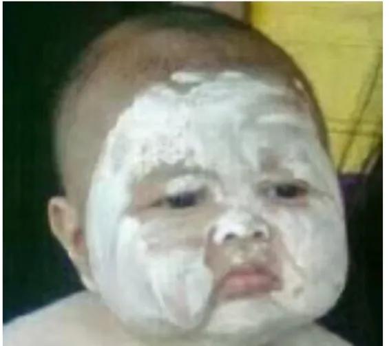 婴儿湿疹的护理及预防,宝宝湿疹怎么护理视频