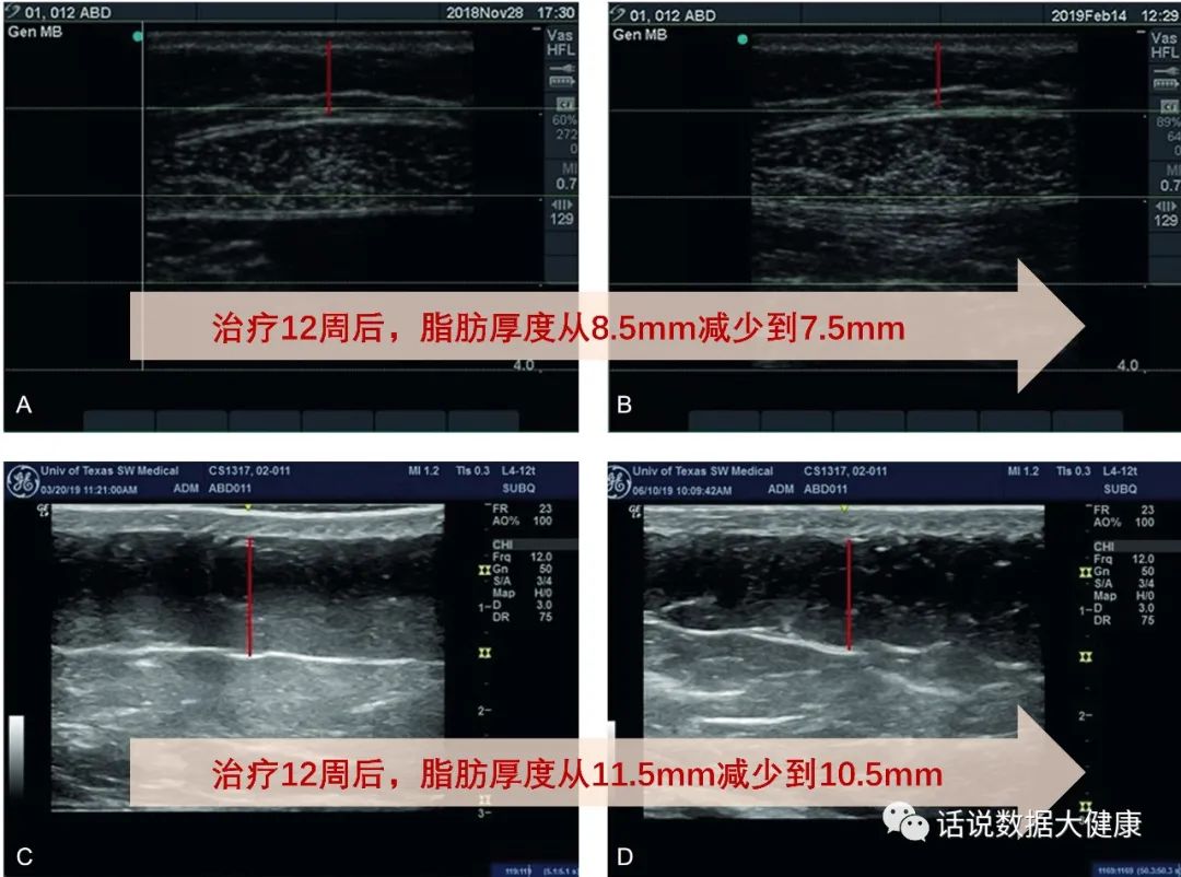 激光减脂，又一个明星医美产品，效果如何？