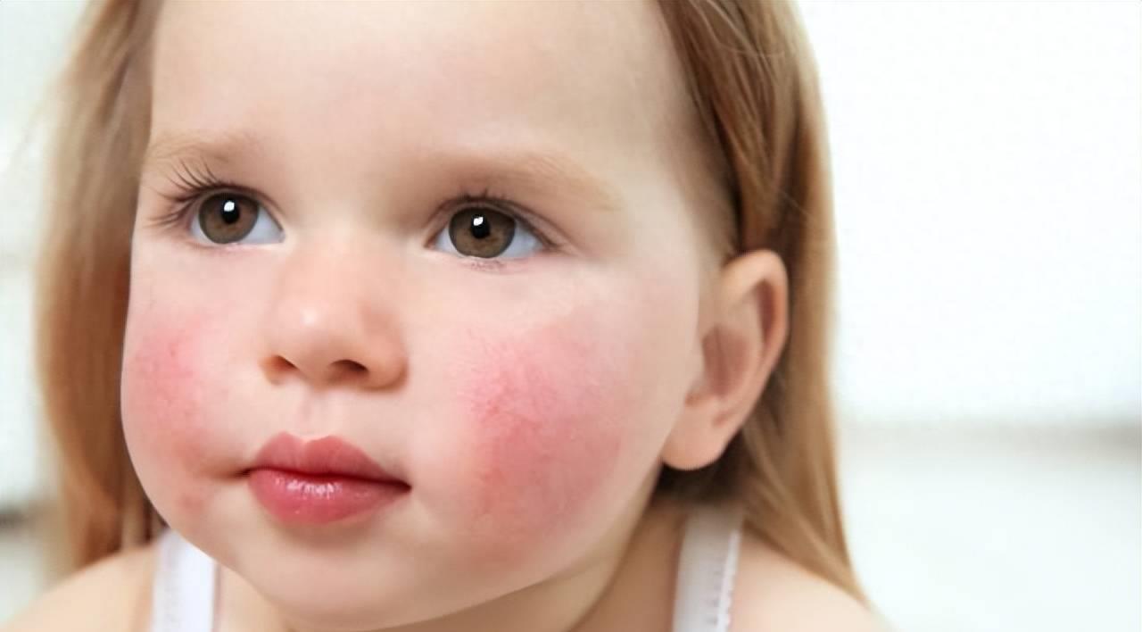 夏日宝宝皮肤红痒,宝宝脸干红痒起疙瘩怎么办