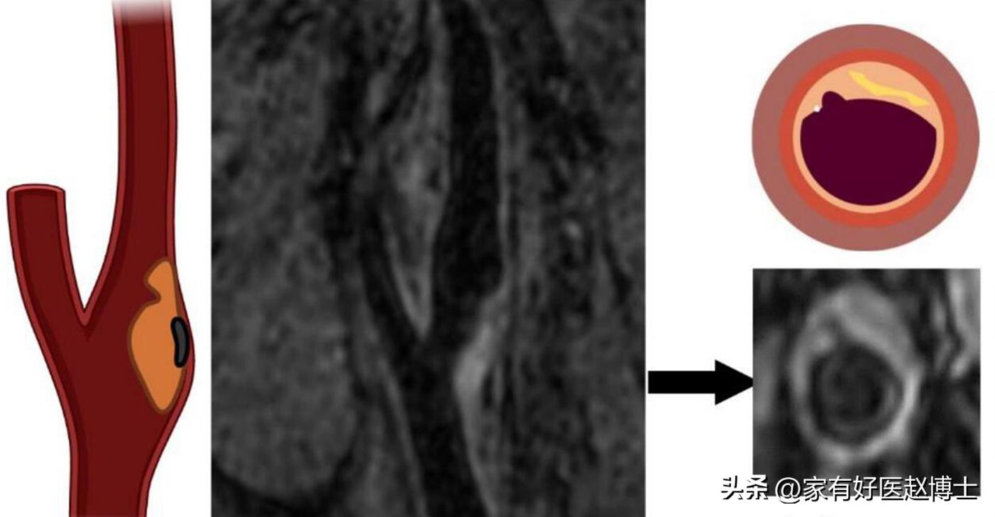 颈动脉没有斑块可以停用他汀吗,一般他汀吃多久颈动脉斑块有效果