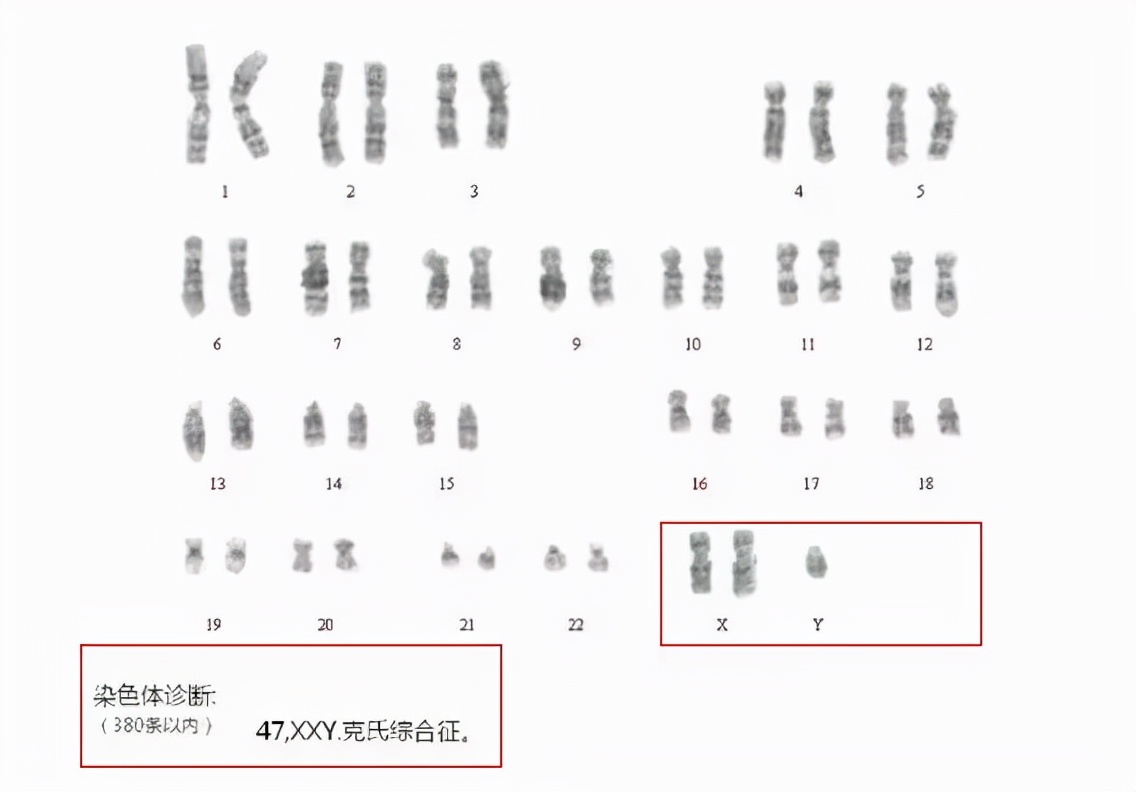 男性染色体导致不育可以治愈吗,男性不育症中最常见的染色体异常