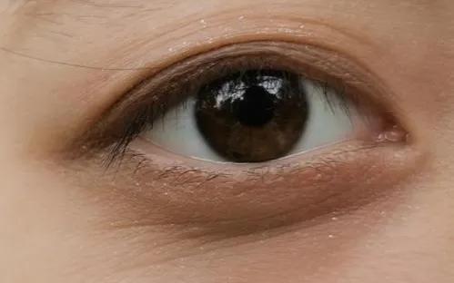 才19岁脸上就起皱纹了是缺什么,19岁就有很重的眼角细纹了