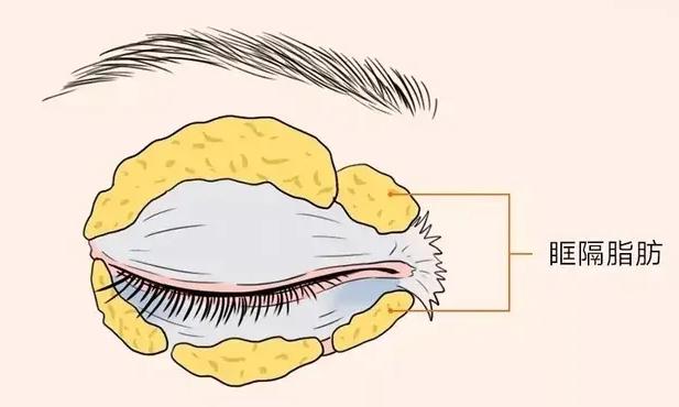 眼袋的形成和解决,形成眼袋的原因是什么