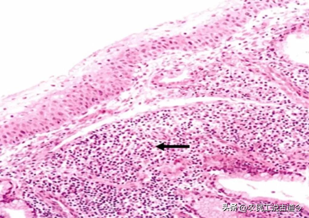 活检报告子宫颈慢性炎症,宫颈活检能查出子宫内的病吗