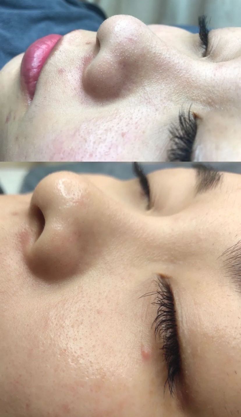 鼻子毛孔大能挤出好多脂肪粒,鼻子上长了像脂肪粒的东西