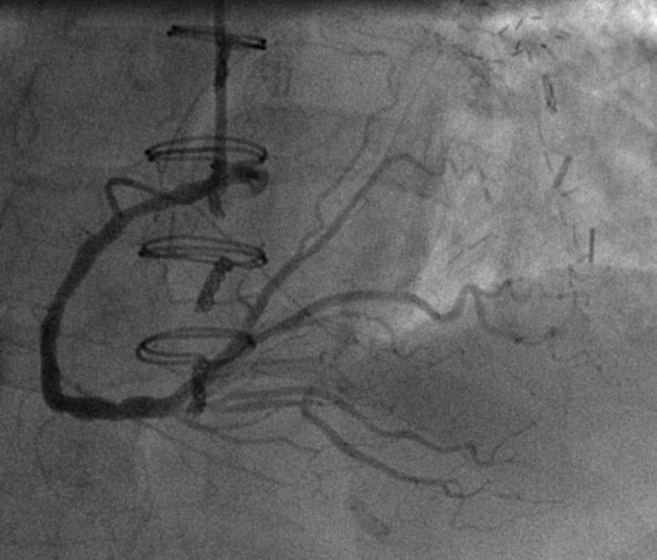 无创血管搭桥手术的全过程,血管闭塞介入手术指征