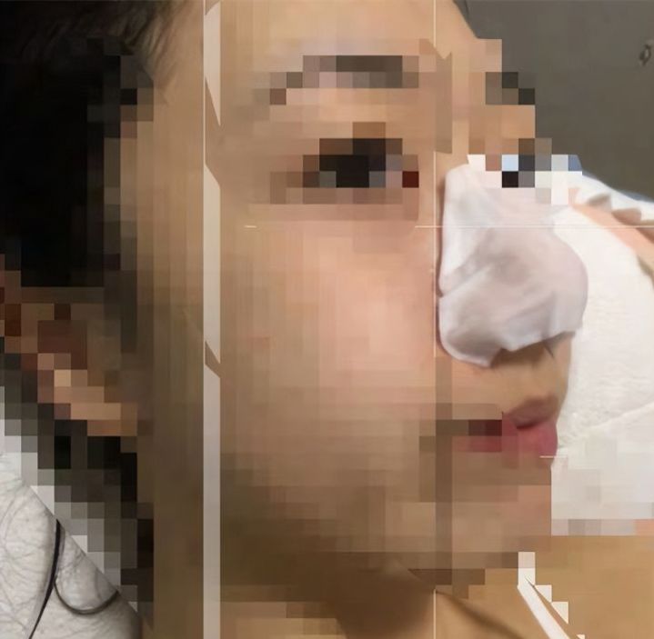 挤鼻子上的黑头和粉刺,鼻子上的粉刺该不该挤