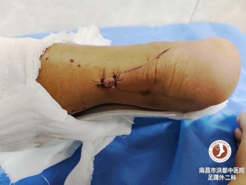 足球运动员跟腱撕裂手术,运动员跟腱断裂接受治疗全过程