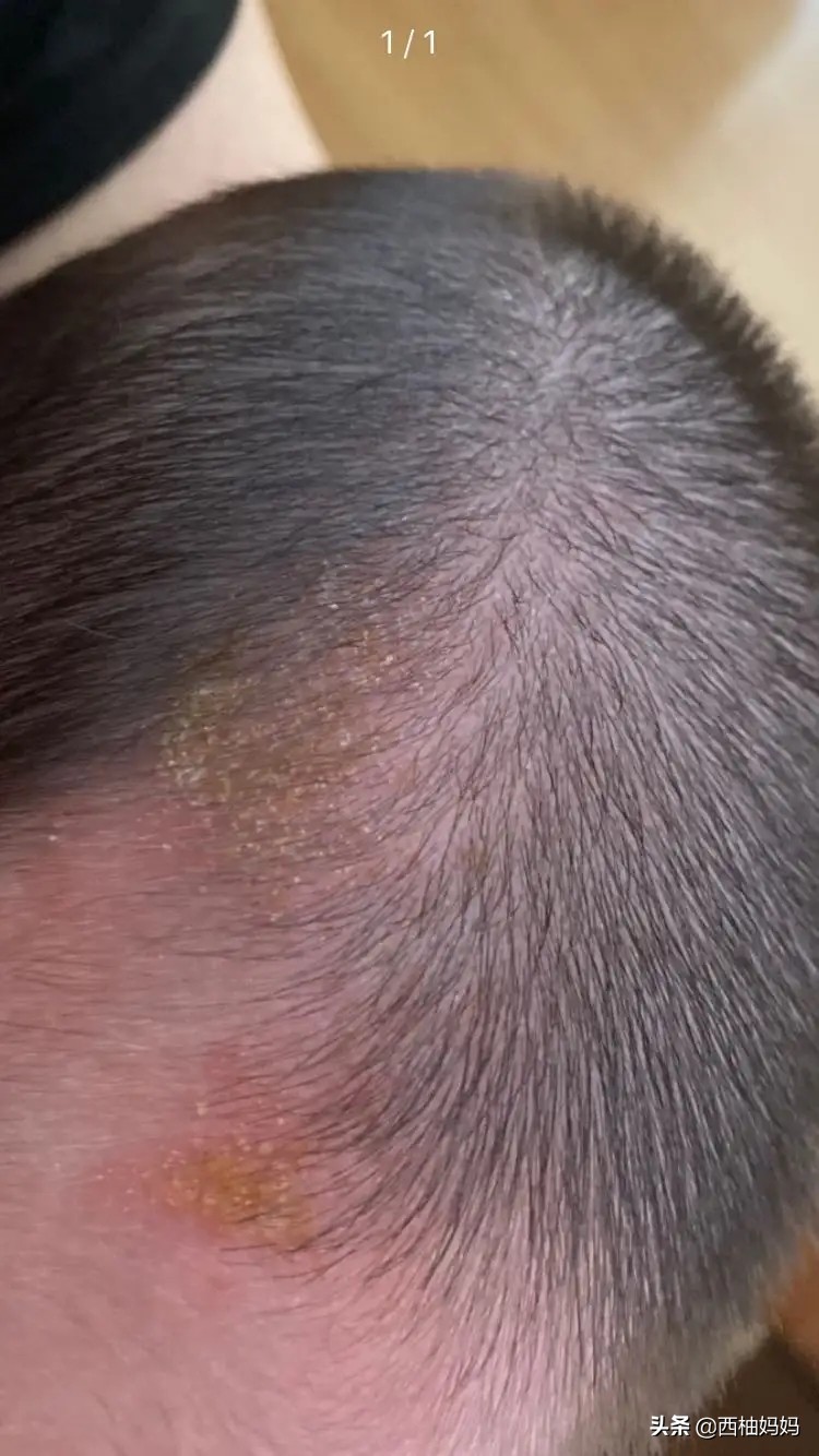 有湿疹的宝宝过敏是什么样的,宝宝过敏引起的湿疹需要去医院吗