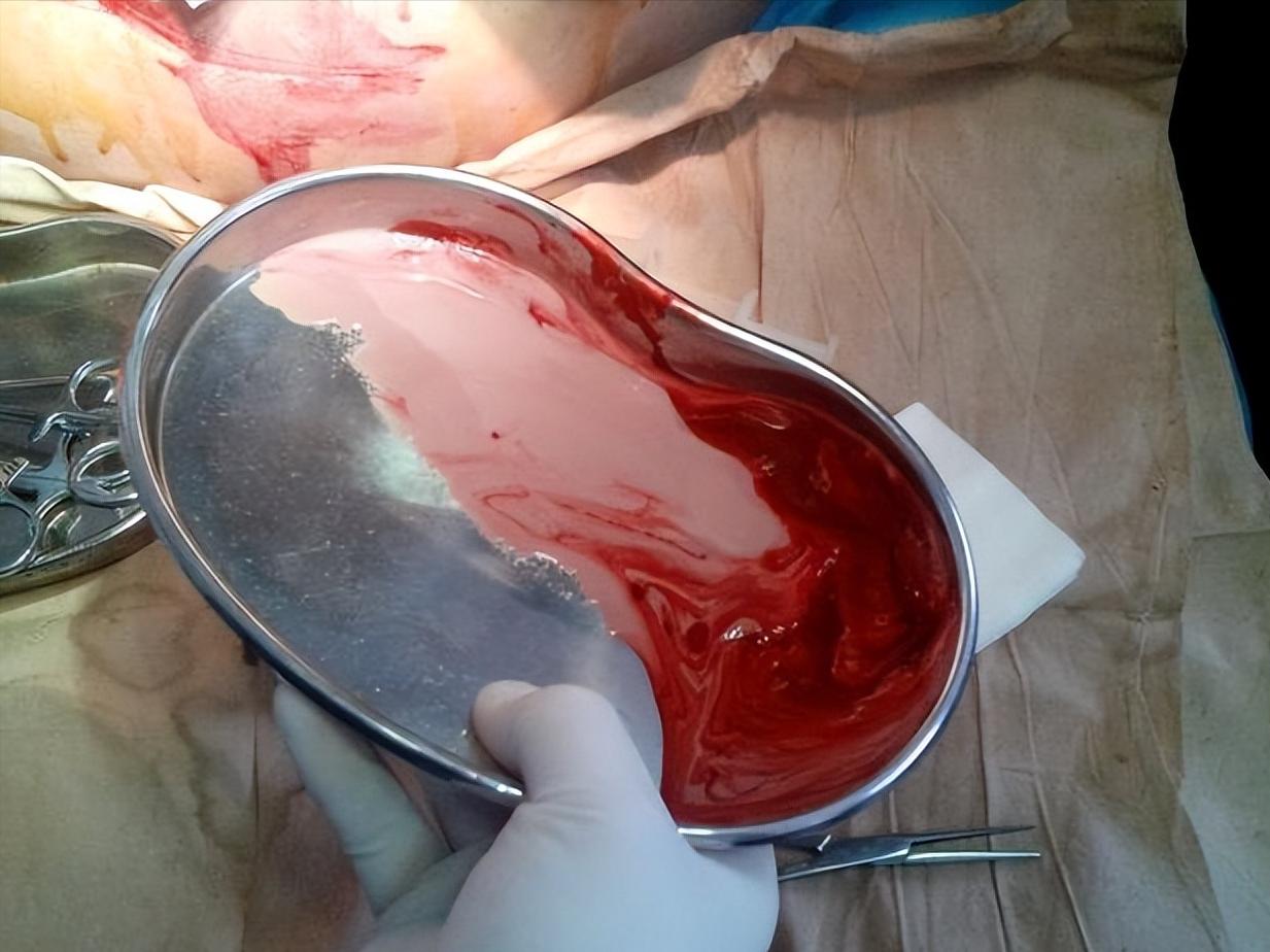 肛周脓肿中医三黄膏,紫草膏可以治肛周脓肿吗