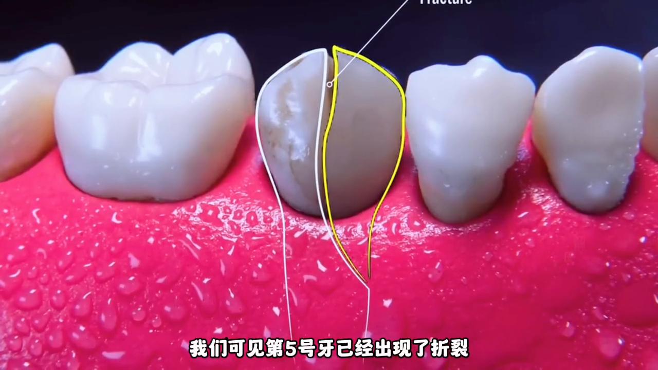 大牙劈裂到种植牙全过程,沉浸式牙齿根管治疗