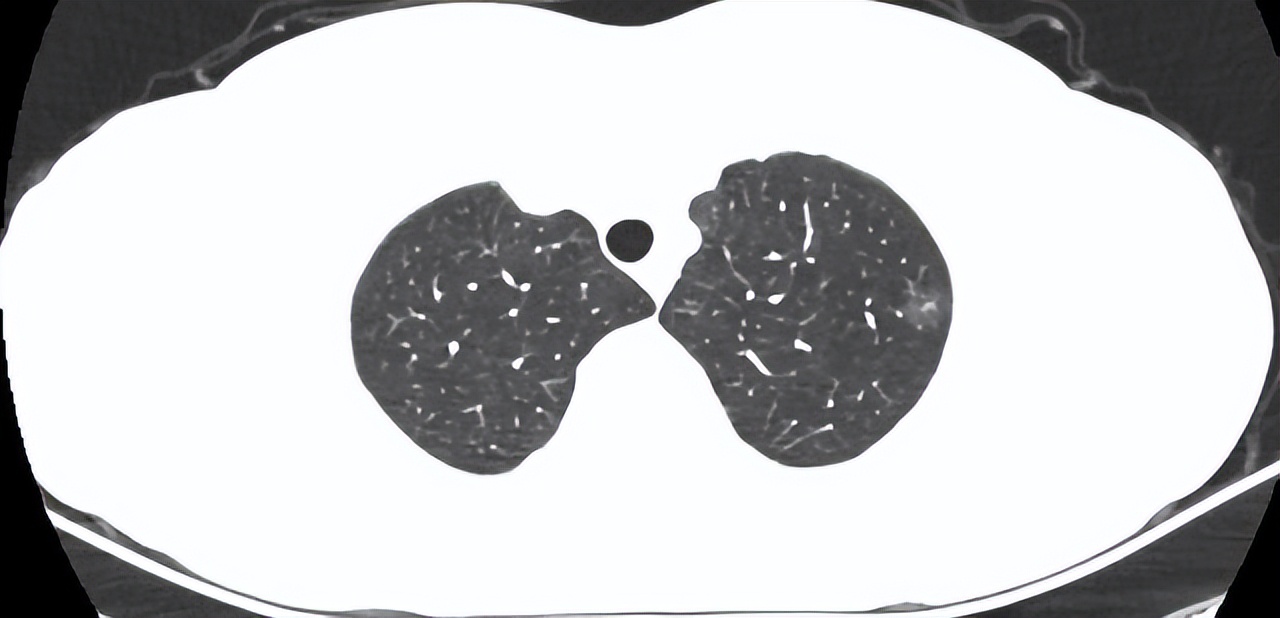 肺结节2x2mm实性结节是癌吗,4毫米结节是肺结节是癌前病变吗