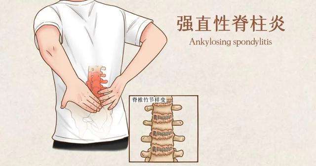强直性脊柱炎算不死的癌症吗,强直性脊柱炎被称为不死的癌症吗