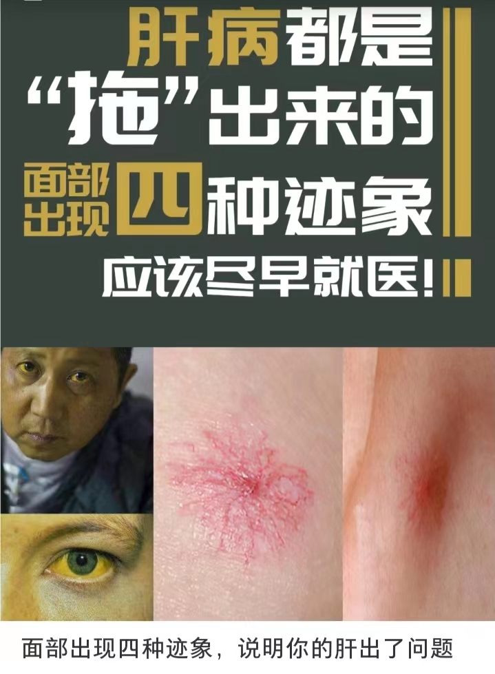 福建省疾控援莆专家组,龙岩二院感染科