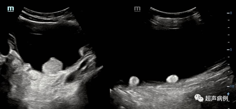 超声上第一次看到孩子的感受,超声检查实录