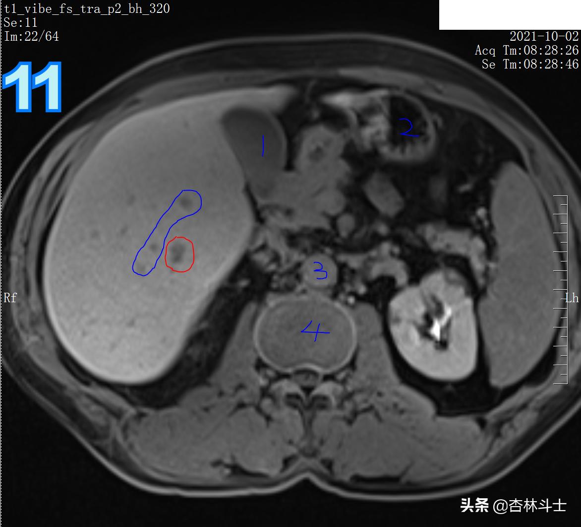 肝癌8公分肿瘤能活多久,肝癌细胞最大长多大