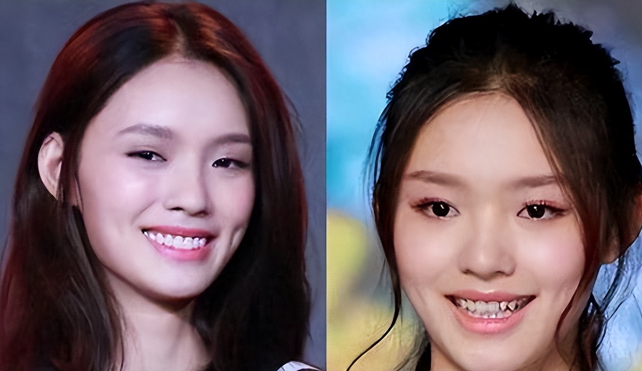 明星嘴突戴牙套前后对比,明星和假牙