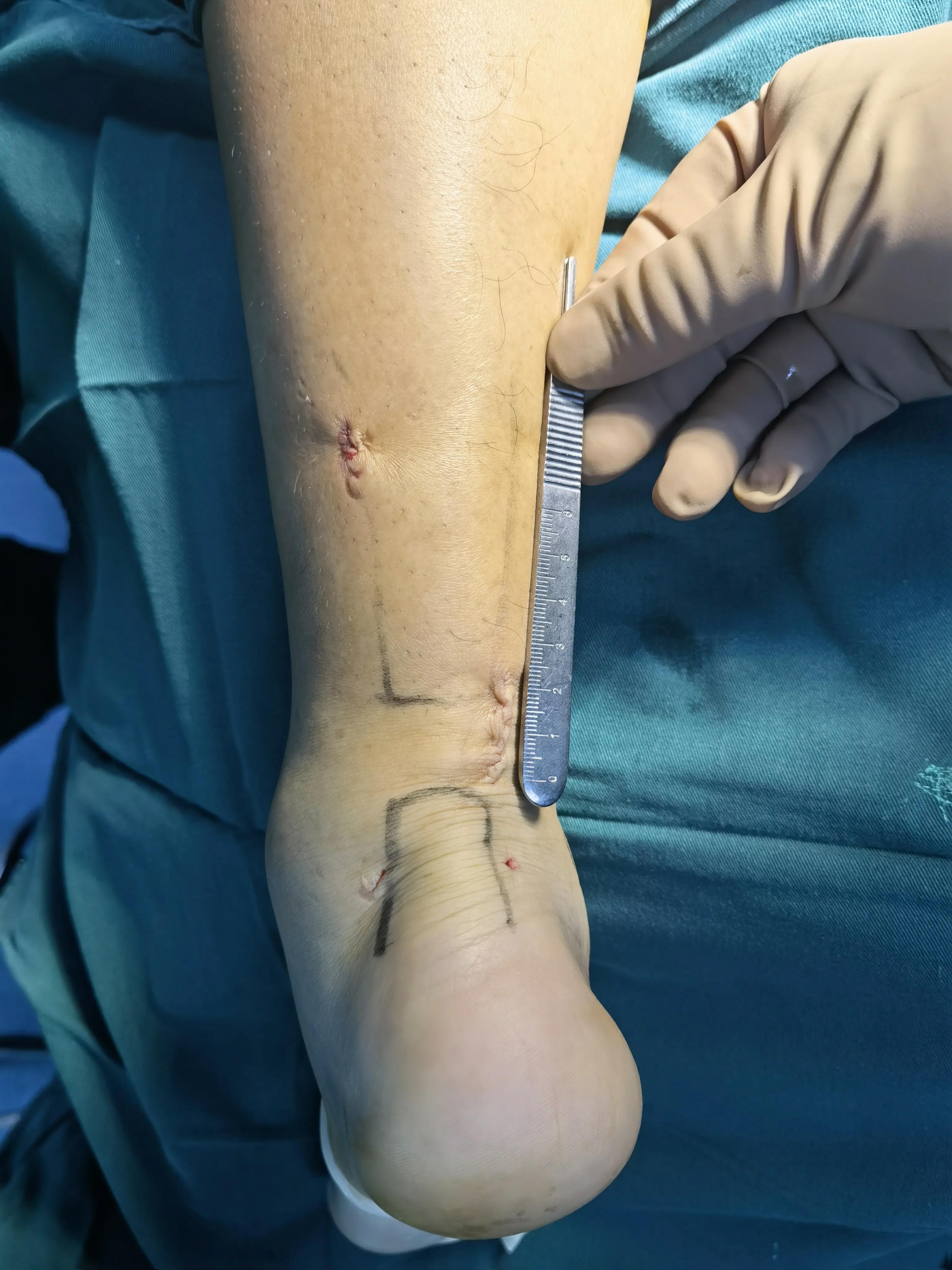 跟腱断裂术后疤痕增生怎么办,跟腱断裂术后跟腱如何愈合