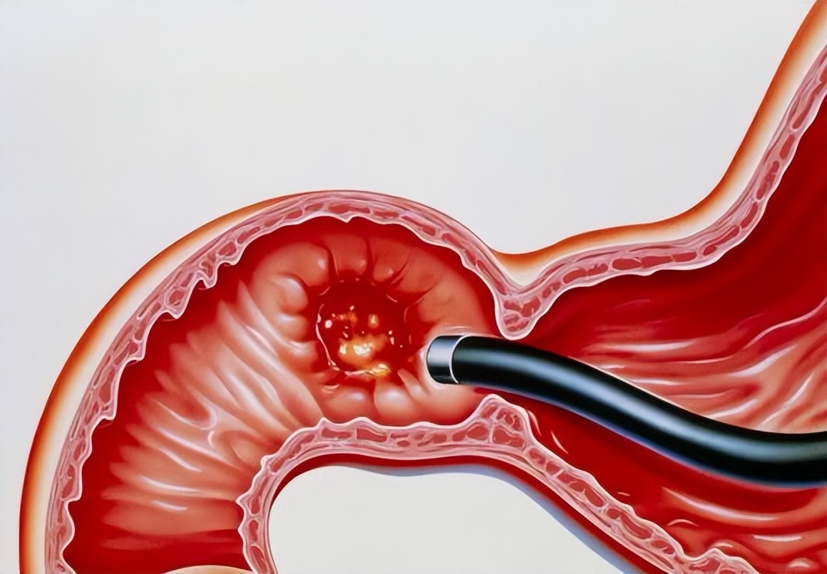 胃镜多长时间做一次比较合理,胃镜多久做一次最合理