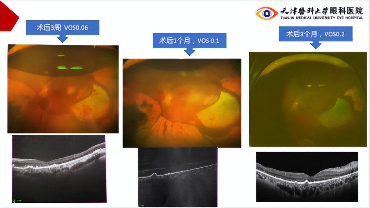 李筱荣教授,天津医科大学眼科医院李筱荣