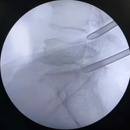 门医技术|门头沟区医院骨二科成功应用微创椎间孔镜技术治疗两例腰椎管多节段狭窄症
