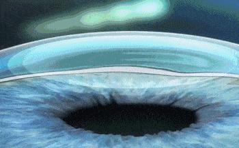 本想做近视手术，却发现眼底上破了个“洞”！需不需要治疗？