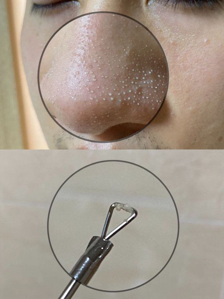 鼻子上的黑头会长毛么,鼻子上的黑头会蔓延到脸上吗