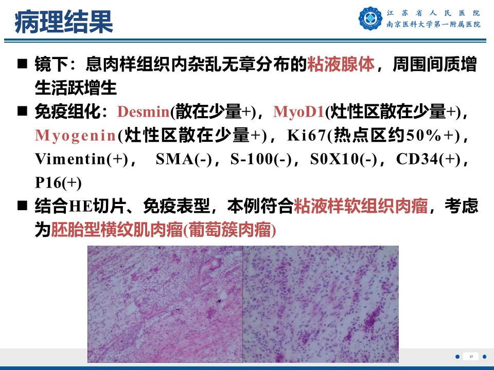 好文分享——《胚胎型横纹肌肉瘤》