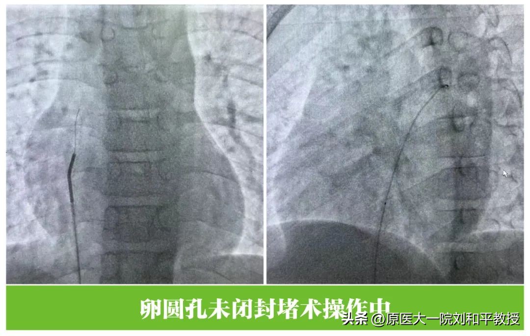 【远东技术】莫名头痛需医“心”，无痕介入巧堵“洞”