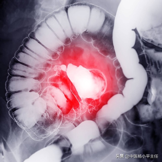 溃疡性结肠炎腹痛老不好怎么办,溃疡结肠炎最近腹痛便血严重