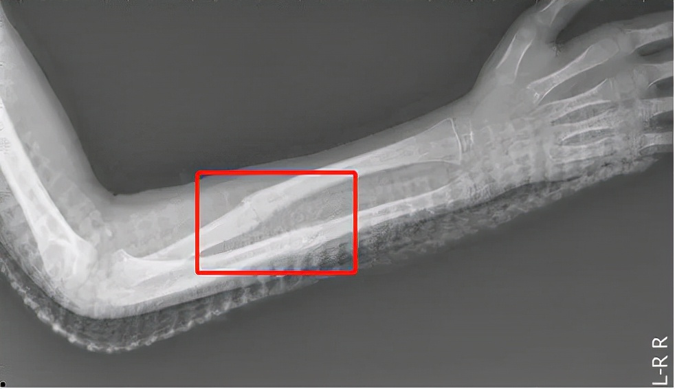 骨骼一碰就碎是什么病,骨骼一碰就碎