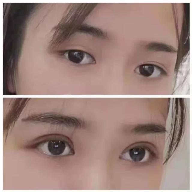 想割双眼皮怕失败,割双眼皮踩雷了应该找医院吗