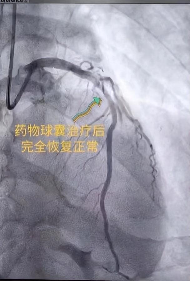 西安市红会医院：肚子疼痛多日检查后竟是心梗医生：警惕无痛性心肌梗死