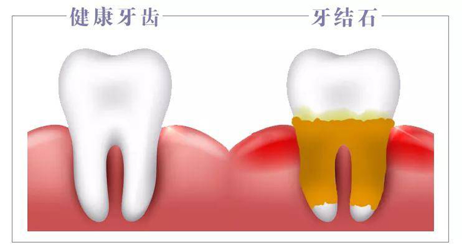 肾结石和胆结石哪个能排出石头,牙结石肾结石胆结石