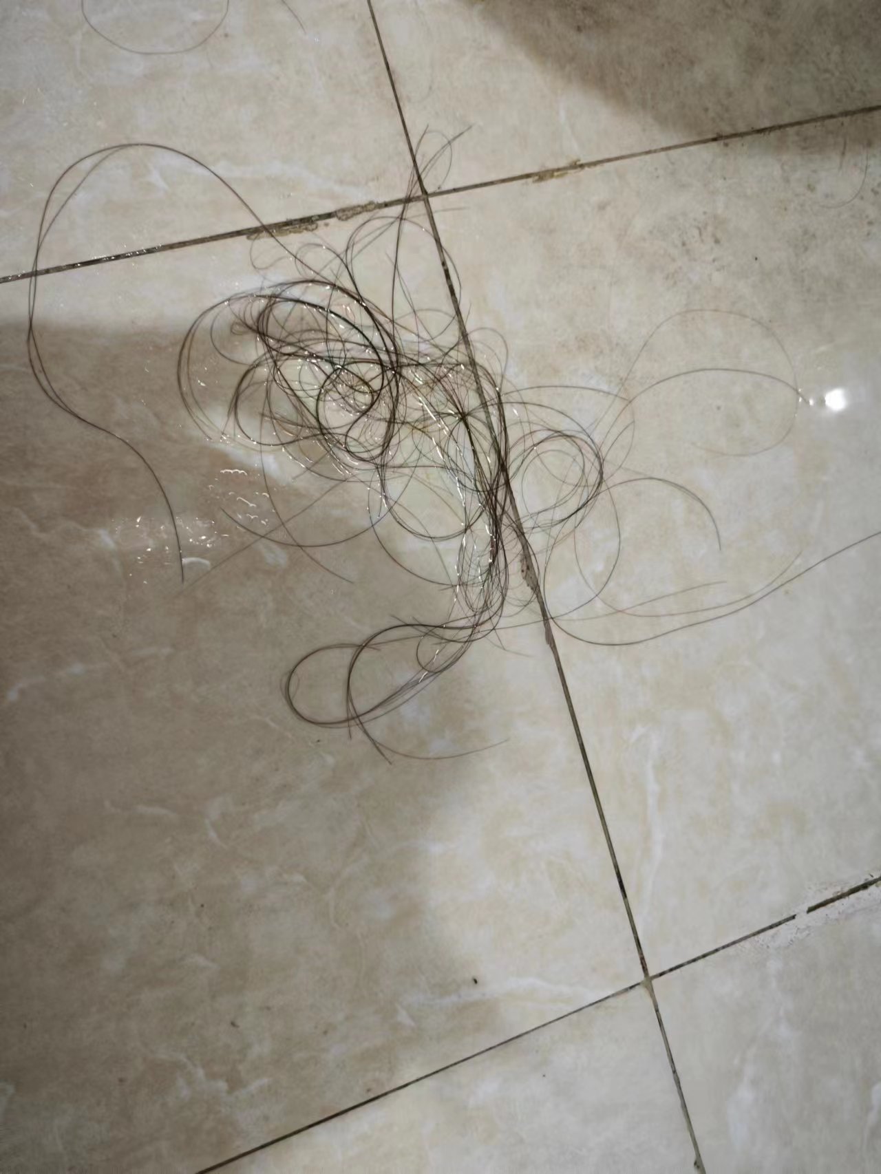 米诺地尔掉头发更严重,使用米诺地尔6个月掉头发正常吗