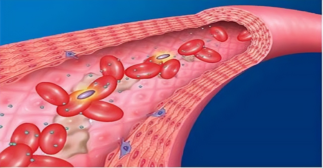 每天吃一片阿司匹林防癌,阿司匹林能软化血管吗