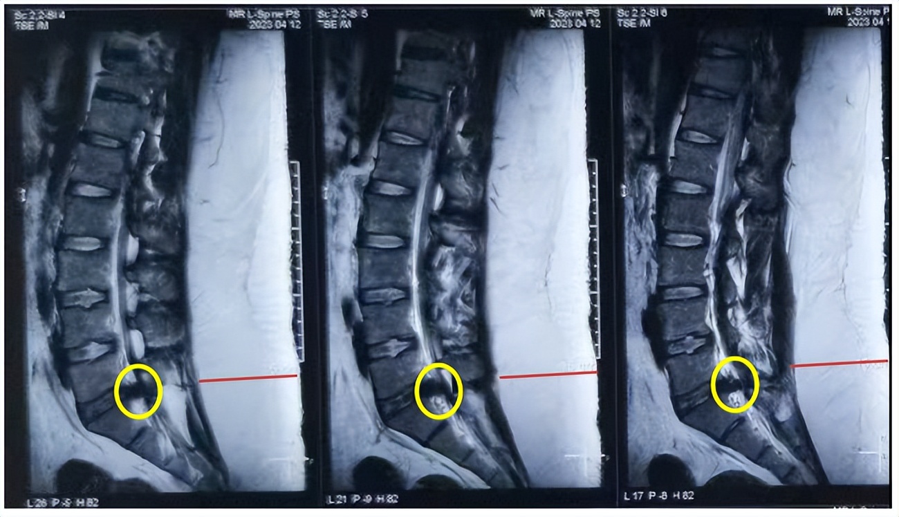 腰椎间盘突出微创姑息法,38岁腰椎间盘突出微创
