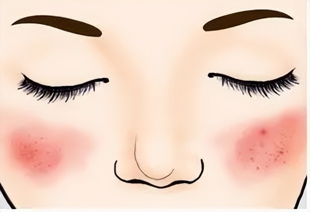 脸部泛红有红血丝怎样淡化,怎么改善脸上的红血丝