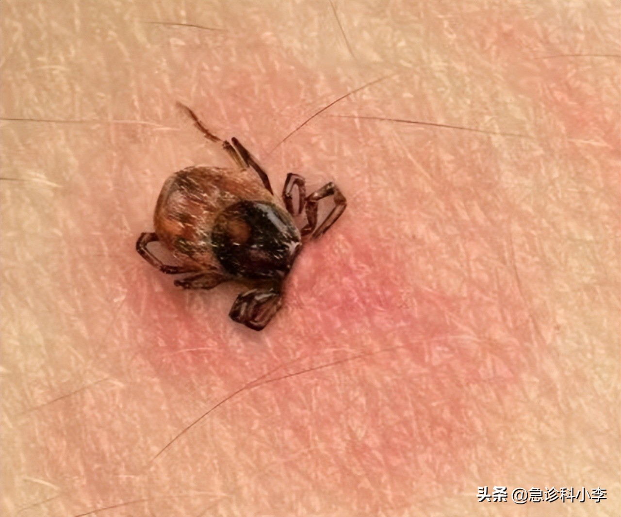 夺命蜱虫咬了是什么样子,夺命蜱虫一家三口被咬两人丧命