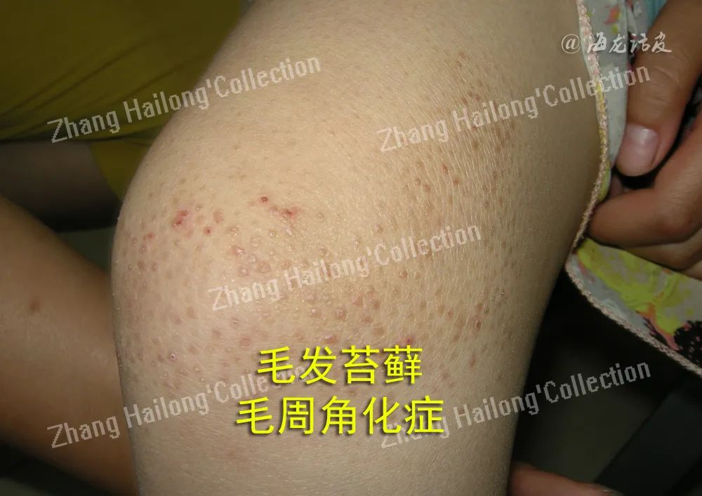 如何拯救鸡皮肤,如何拯救油腻鸡皮肤