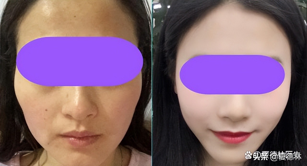 颧骨突出适合做服帖吗,颧骨凹陷适合做什么项目