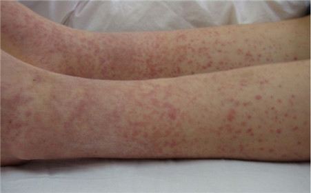 男童大腿内侧出现红斑块,小儿下肢皮肤花斑的原因