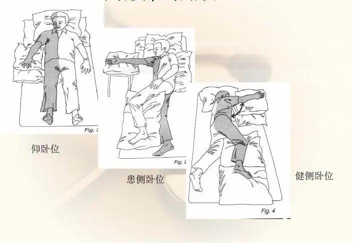 偏瘫并发症有哪些,怎么预防偏瘫并发症