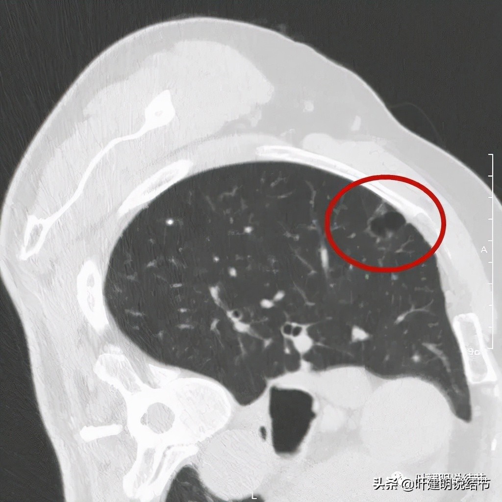 肺多发结节切除一个剩下的怎么办,无限纠结的肺小结节